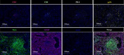 Low MxA Expression Predicts Better Immunotherapeutic Outcomes in Glioblastoma Patients Receiving Heat Shock Protein Peptide Complex 96 Vaccination